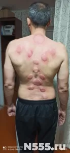 Баночный массаж по древним методикам в Оренбурге